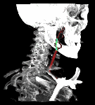 Stent Carotid Stenosis I